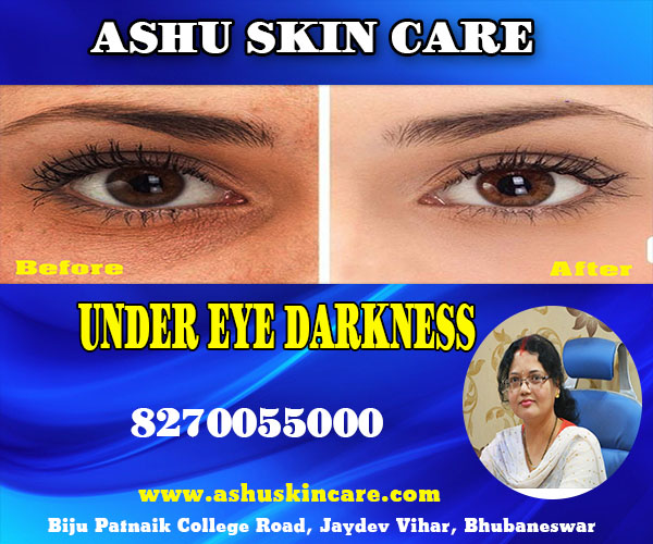 best under eye darkness treatment clinic in bhubaneswar near me - dr anita rath